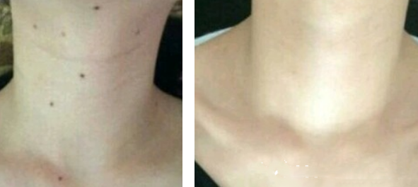 軍隊(duì)總醫(yī)院張小平激光斑痣療觀察