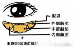 抽脂去眼袋后眼部皮膚會變得松弛？有什么辦法補救？