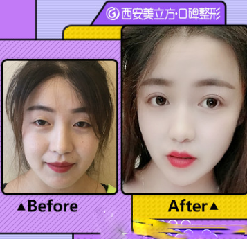西安美立方醫(yī)療美容醫(yī)院隆鼻真人案例