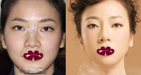 在合肥華美整形美容醫(yī)院做玻尿酸隆鼻案例前后對比圖