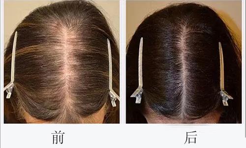 頭發(fā)種植還有這一些副作用！絕大部分醫(yī)生不可能對(duì)你說