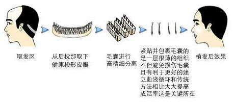 頭發(fā)種植還有這一些副作用！絕大部分醫(yī)生不可能對(duì)你說