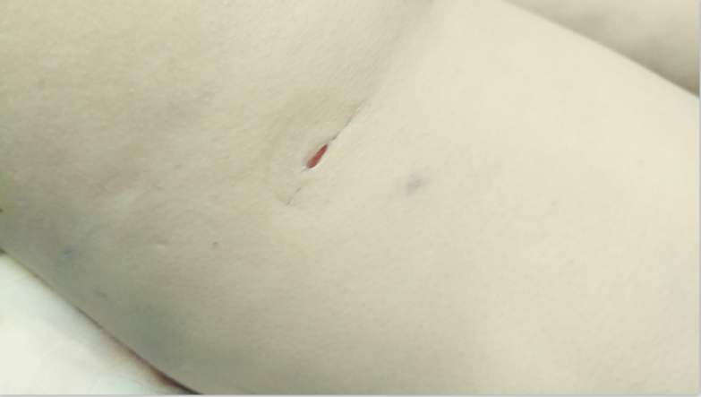 脂肪填充后的針眼疤痕，該怎樣清除？