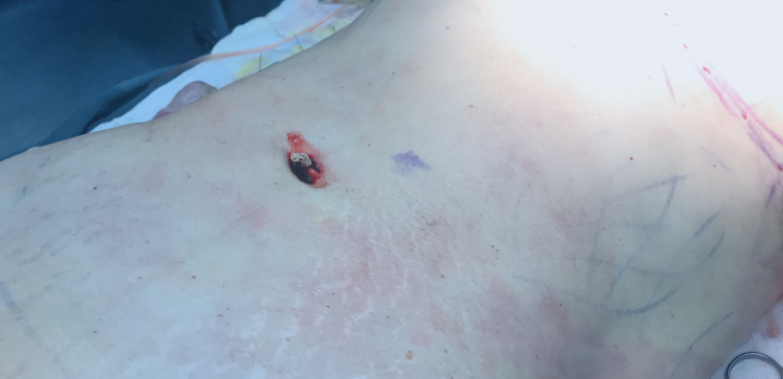 脂肪填充后的針眼疤痕，該怎樣清除？