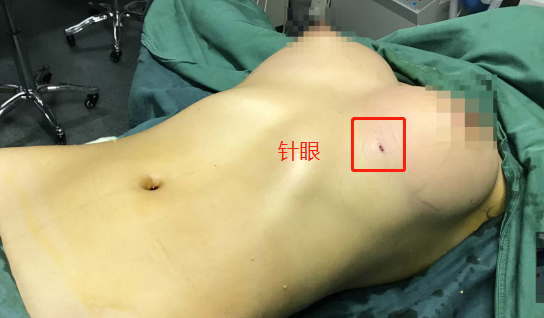 脂肪填充后的針眼疤痕，該怎樣清除？