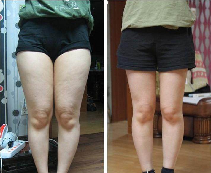 腰腹部環(huán)吸+大腿吸脂手術，讓人體會截然不同的你~