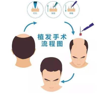 許多人關(guān)注的問題：種植的頭發(fā)是否會(huì)掉？