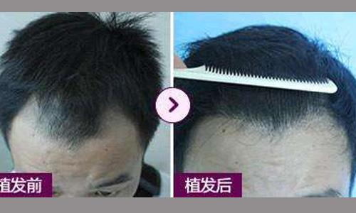 許多人關(guān)注的問題：種植的頭發(fā)是否會(huì)掉？