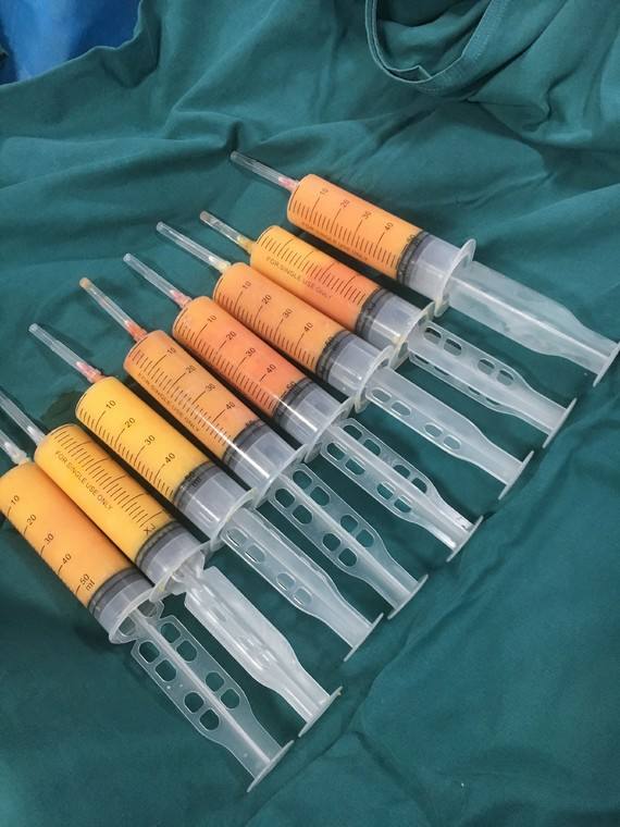 吸脂果怎么樣？可不可怕？就看這幾個方面