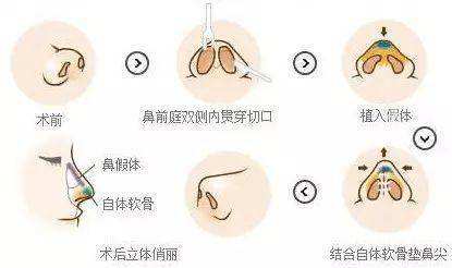 隆鼻手術(shù)如何做？詳盡步驟講解一下下