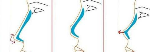 隆鼻手術(shù)如何做？詳盡步驟講解一下下