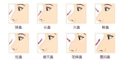 隆鼻手術(shù)如何做？詳盡步驟講解一下下