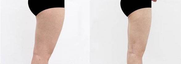 大腿吸脂手術(shù)需要多久？全部手術(shù)調(diào)節(jié)流程方法步驟