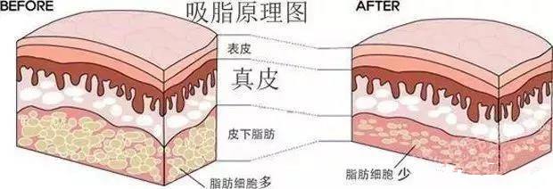 大腿吸脂手術(shù)需要多久？全部手術(shù)調(diào)節(jié)流程方法步驟