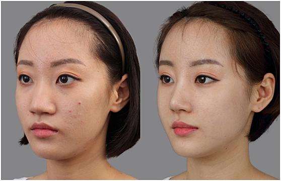 鼻頭縮小術(shù)價錢費用，醫(yī)院收費標(biāo)準(zhǔn)詳細(xì)信息