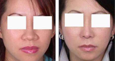 鼻頭縮小術(shù)價錢費用，醫(yī)院收費標(biāo)準(zhǔn)詳細(xì)信息