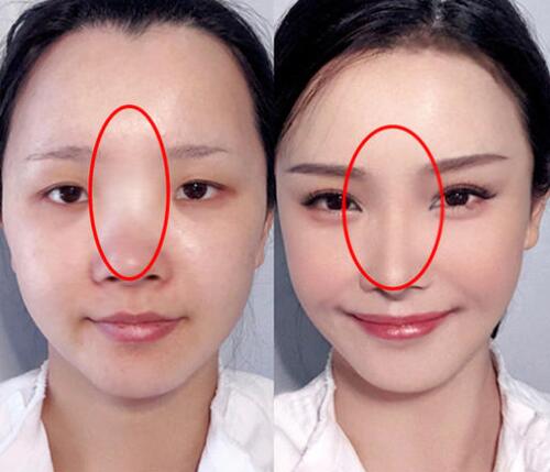 鼻頭縮小術(shù)價錢費用，醫(yī)院收費標(biāo)準(zhǔn)詳細(xì)信息