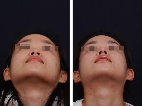 鼻頭縮小術(shù)價錢費用，醫(yī)院收費標(biāo)準(zhǔn)詳細(xì)信息