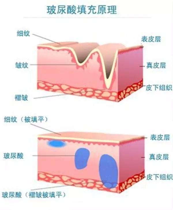 給你們瞧瞧玻尿酸注射的不良反應，看完你還敢反復注射？