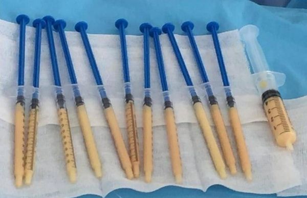 自體脂肪隆鼻手術(shù)的有關(guān)講解，長知識了