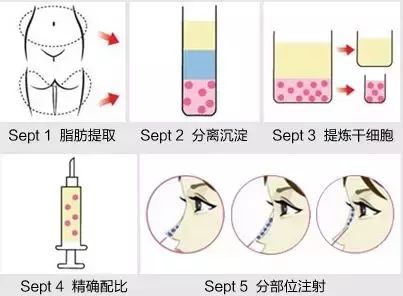 自體脂肪隆鼻手術(shù)的有關(guān)講解，長知識了