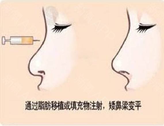 自體脂肪隆鼻手術(shù)的有關(guān)講解，長知識了