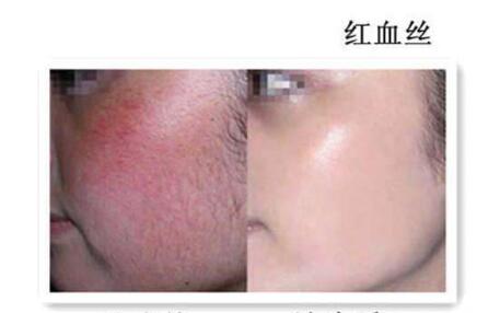 激光祛紅血絲沒問題可靠嗎？說真的絲毫都不喜歡“高原紅”