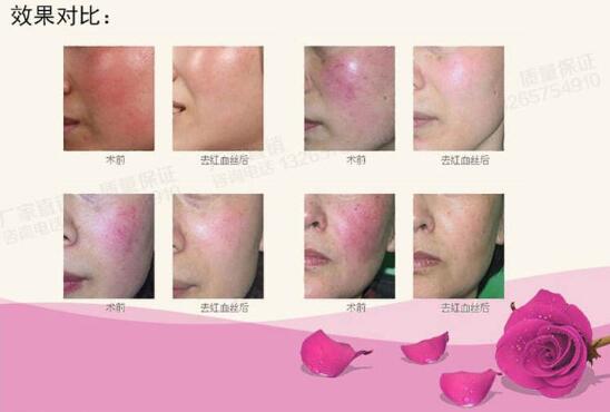 激光祛紅血絲沒問題可靠嗎？說真的絲毫都不喜歡“高原紅”