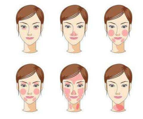 激光祛紅血絲沒問題可靠嗎？說真的絲毫都不喜歡“高原紅”