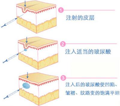 快30歲十分關(guān)注：注射玻尿酸除皺沒問題可靠嗎？猶豫不決該不該做