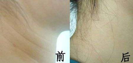 快30歲十分關(guān)注：注射玻尿酸除皺沒問題可靠嗎？猶豫不決該不該做