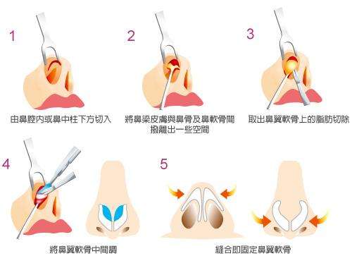 手術(shù)調(diào)節(jié)縮小鼻子的具體方法，技術(shù)總結(jié)