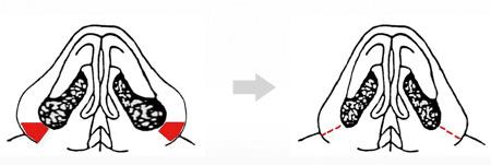 手術(shù)調(diào)節(jié)縮小鼻子的具體方法，技術(shù)總結(jié)