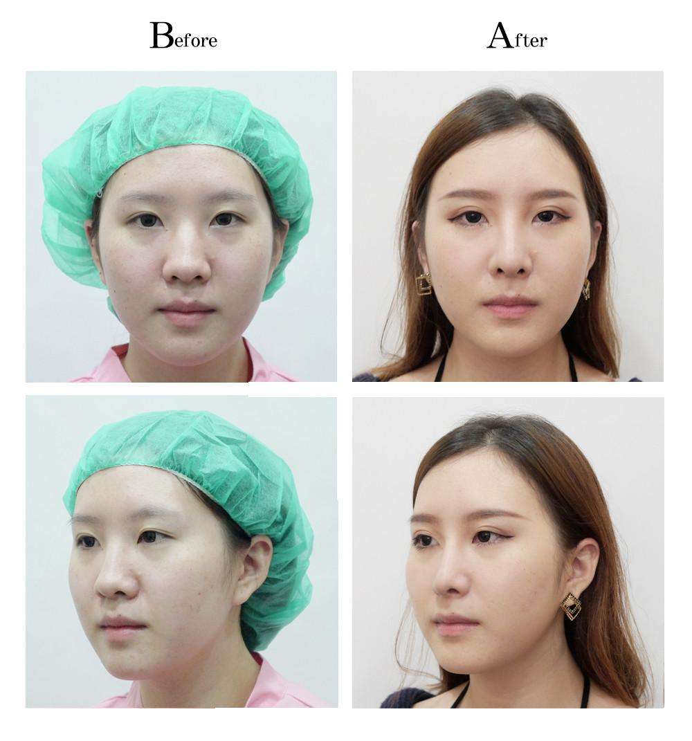 手術(shù)調(diào)節(jié)縮小鼻子的具體方法，技術(shù)總結(jié)