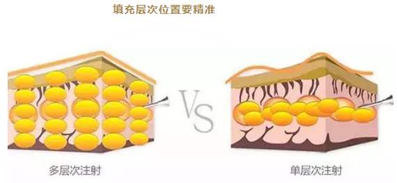 做了脂肪填充過(guò)后是否會(huì)發(fā)生腫塊、凸凹不平的狀況？