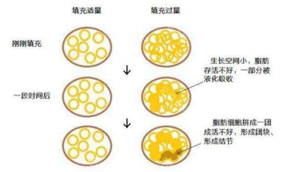 做了脂肪填充過后，是否會迅速就吸收掉？