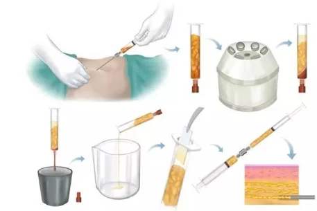 做了脂肪填充過后，是否會迅速就吸收掉？