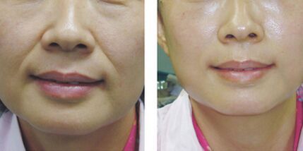 鼻溝紋除皺的方法大全，這幾種具體方法當(dāng)下很流行！