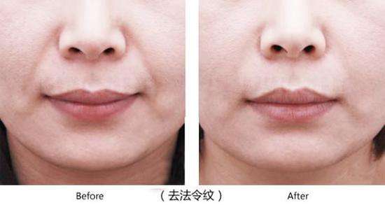 鼻溝紋除皺的方法大全，這幾種具體方法當(dāng)下很流行！