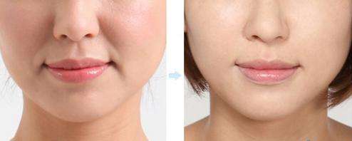 鼻溝紋除皺的方法大全，這幾種具體方法當(dāng)下很流行！