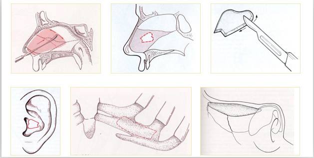 自體耳軟骨墊鼻尖價錢、后遺癥、整體果圖