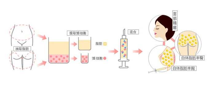 臉部脂肪填充會(huì)讓臉變寬嗎？據(jù)說臉會(huì)變寬……
