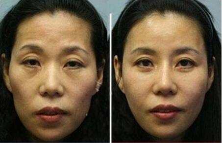 臉部脂肪填充會(huì)讓臉變寬嗎？據(jù)說臉會(huì)變寬……