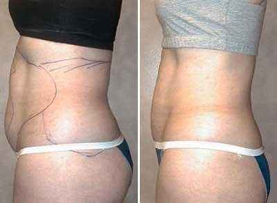 做抽脂手術(shù)失敗的幾率大不大？副作用有哪些？