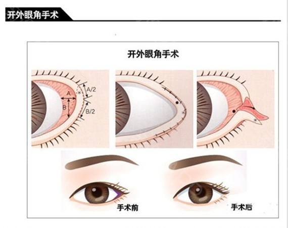 外眼角開大不令人滿意，能夠如何修復(fù)呢？