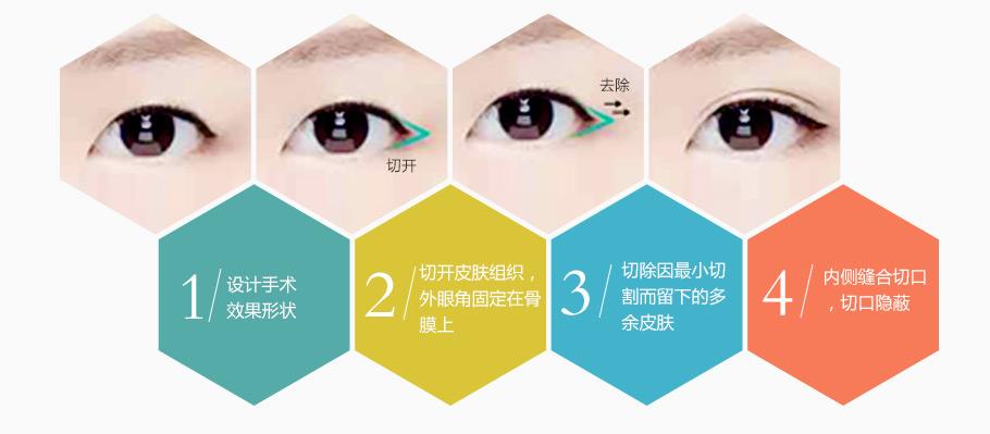外眼角開大不令人滿意，能夠如何修復(fù)呢？