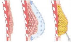 注射隆胸的優(yōu)勢：這就是有些人胸大的秘密
