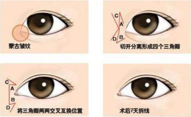 開(kāi)眼角手術(shù)