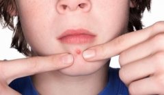 下巴長痘反反復(fù)復(fù)？分析一下可能是這4種原因！
