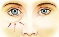 去眼袋方法這么多怎么選？4種眼袋類型調(diào)節(jié)方法有差異！